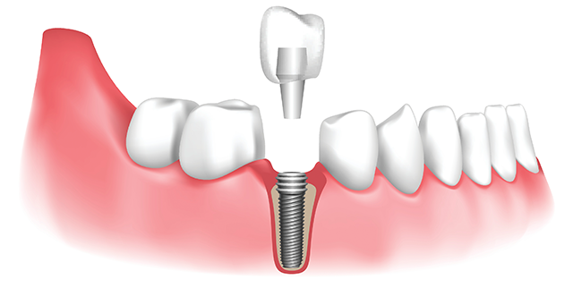 https://mbdental.ma/wp-content/uploads/2023/04/dental-implant-640x322.webp