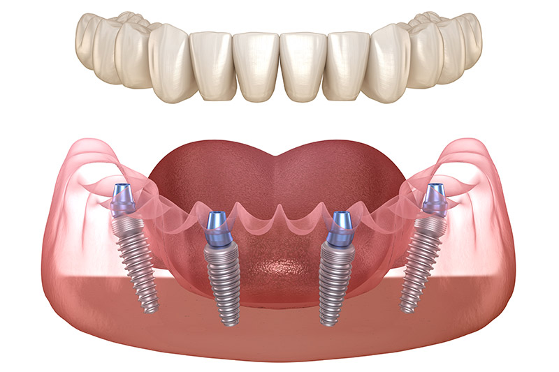 https://mbdental.ma/wp-content/uploads/2023/11/all-on-4-implant-dentaire-dental-implants.jpg