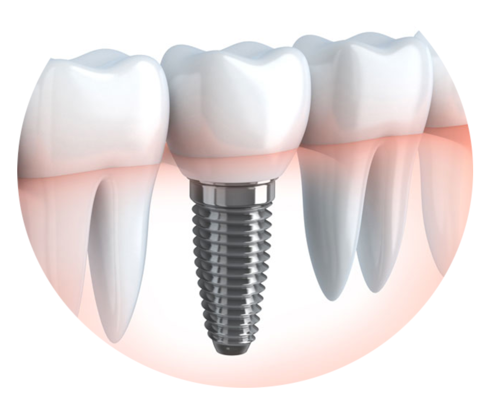 https://mbdental.ma/wp-content/uploads/2023/11/implant-1-e1698887028527.png