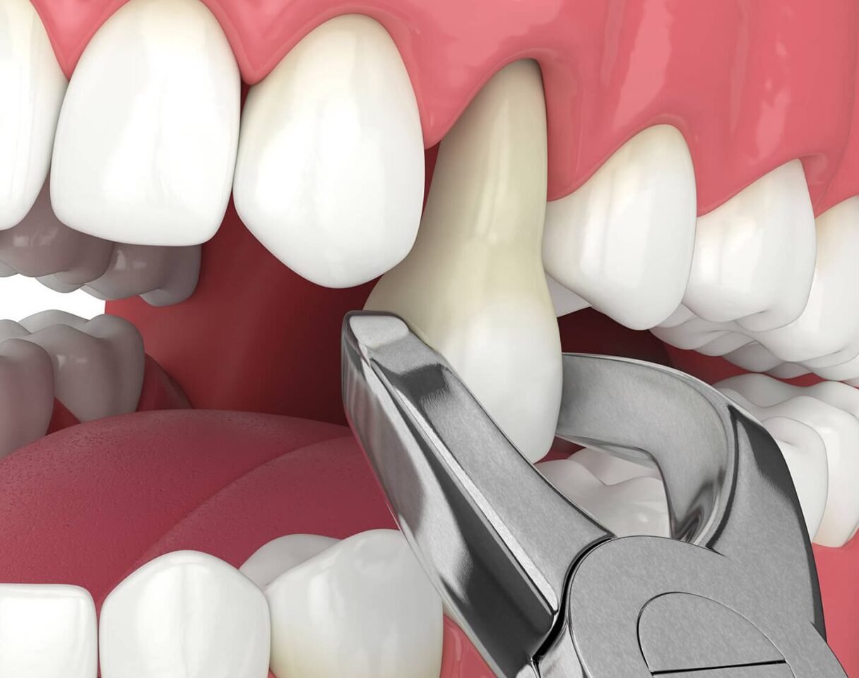 Dissolvant Enzymatique Naturel Pour Caries Dentaires – Soin Dentaire Alternatif – Marque Brix